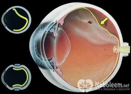 Общо отлепване на ретината - диагностика, лечение