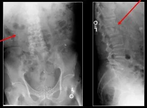 Tuberkolitikus spondylitis a gerinc tünetei és kezelése