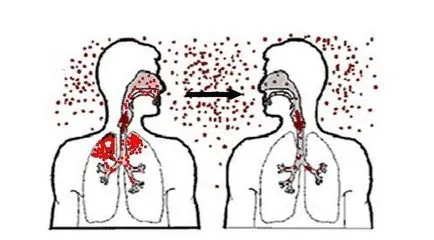 Tuberkolitikus spondylitis a gerinc tünetei és kezelése