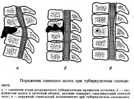 spondilita tuberculoasă a coloanei vertebrale simptome si tratament