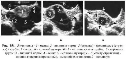 Ултразвуково изследване на яйчниците