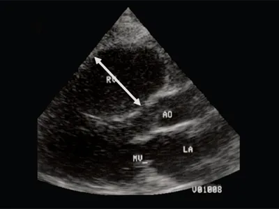 Uzi pentru defecte cardiace congenitale la făt - în special intracardiacă hemodinamica prenatală