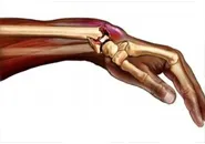 Dislocarea de încheietura mâinii - forme și simptome, de prim ajutor și tratament