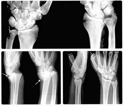 Dislocarea de încheietura mâinii - forme și simptome, de prim ajutor și tratament