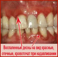 Inflamarea gingiilor, o lume fara a face rau