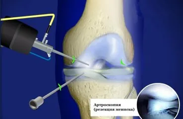 Restaurarea și reabilitarea după îndepărtarea meniscului articulației genunchiului, efectele intervenției chirurgicale