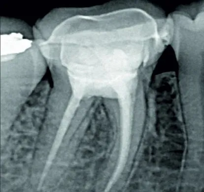 Restaurarea molarilor după tratament endodontic folosind ceramice