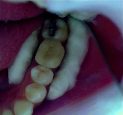 Restaurarea molarilor după tratament endodontic folosind ceramice