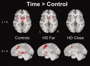 Metode de origine coree, diagnosticarea și controlul lui Huntington