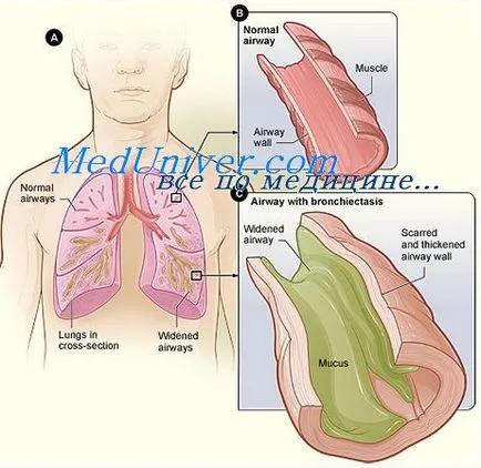 Хирургично лечение на бронхиектазия
