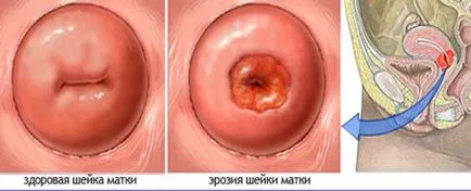 13 седмица от бременността (снимка), на шийката на матката ерозия - лечение (обгарянето с билки, народни средства