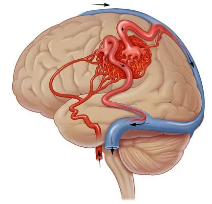 Metoda 3 chirurgie malformație vasculară cerebrală