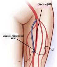 Атеросклерозата на долните крайници операцията - лечение на сърдечна