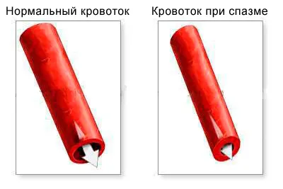 Angiodystonia мозъчно-съдови симптоми при деца, лечение, народни средства