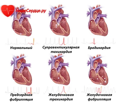 Аритмия видове опасност, каузи