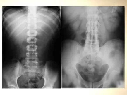 Spondylitis ankylopoetica - Tünetek, jelek, a diagnózis és a kezelés a betegség