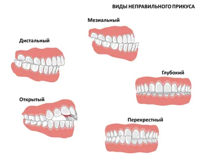 Презрамки на долната челюст на инсталацията като износване