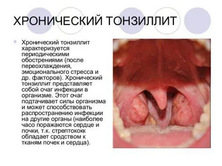 Mint kezelni gennyes mandulagyulladás gyermekek néz ki, mint egy gyerek, mint leöblítjük, 1, 2, 3 éves, az otthon