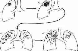 Nu da handicap în tuberculoza pulmonară în România