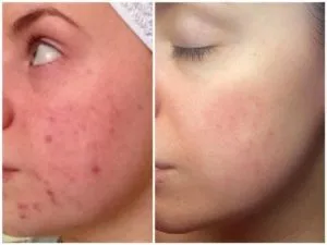Даване на кожата си красотата на необичаен начин от криотерапия е полезно за лицето