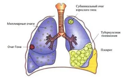 Nu da handicap în tuberculoza pulmonară în România