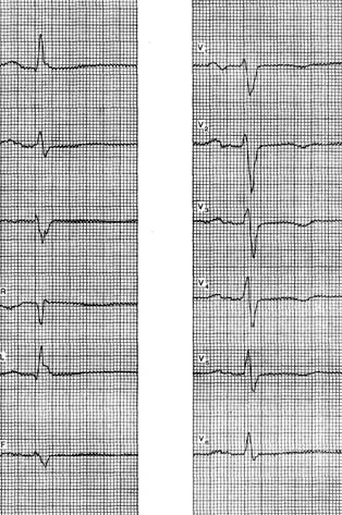 intoxicație digitalică - electrocardiogramei în unele boli și sindroame -