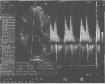 Diagnózisa mitrális stenosis