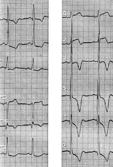 intoxicație digitalică - electrocardiogramei în unele boli și sindroame -