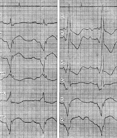 intoxicație digitalică - electrocardiogramei în unele boli și sindroame -