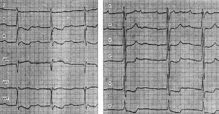 intoxicație digitalică - electrocardiogramei în unele boli și sindroame -