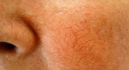 Home jogorvoslatok rosacea