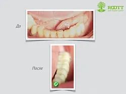 Două etape descriere implantare, pret, citind pe o implantare în două etape