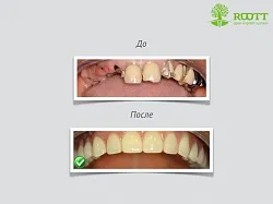 Două etape descriere implantare, pret, citind pe o implantare în două etape