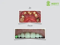 Două etape descriere implantare, pret, citind pe o implantare în două etape