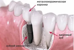 Două etape de implantare