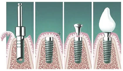 Două etape implanturi dentare 1