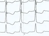 ECG de supradozaj glicozide cardiace, Departamentul de Medicina Interna № 3