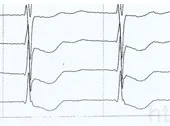 ECG de supradozaj glicozide cardiace, Departamentul de Medicina Interna № 3