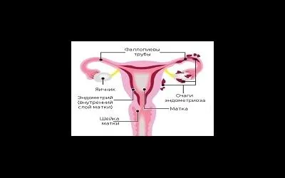 Az endometriózis következményei a betegség, laparoszkópia endometriózis