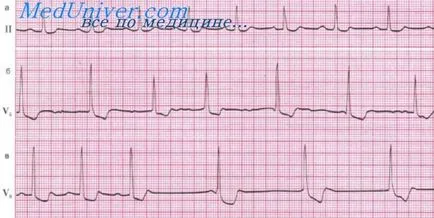 ECG glicozide supradoză