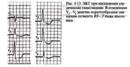 Електрокардиограма с предозиране на сърдечни гликозиди