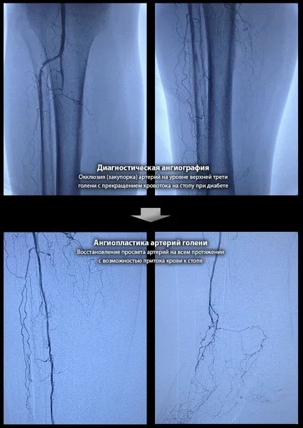 Tratamentul endovascular al piciorului diabetic