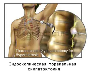 Hyperhydrosis a tenyerek és a láb - tenyéri hyperhidrosis, online magazin