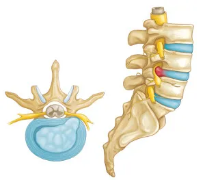 hernie de disc intervertebral cauze, etape, simptome și tratament