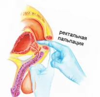 Innovatív eszköz a BPH kezelésére - MAVIT