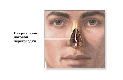 deviatie de sept la copii - simptome, prevenirea și tratamentul de curbură