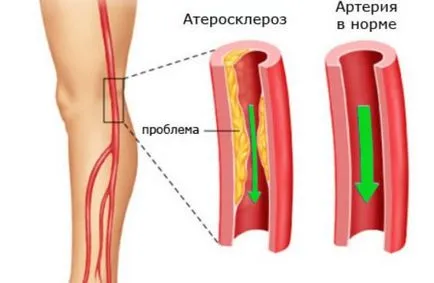 Ischemia din partea inferioara a cauzelor membrelor, simptome, diagnostic și tratament