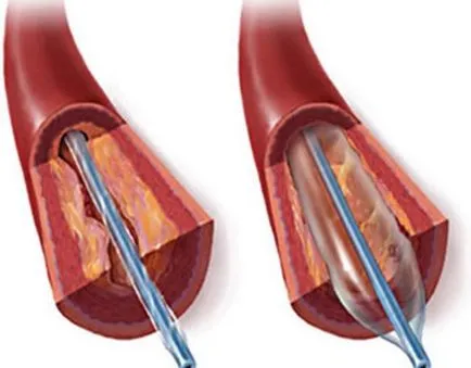 Ischemia din partea inferioara a cauzelor membrelor, simptome, diagnostic și tratament