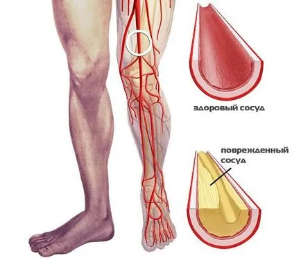 Ischemia din partea inferioara a cauzelor membrelor, simptome, diagnostic și tratament