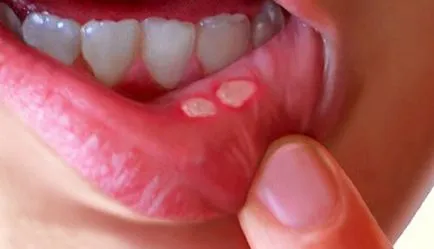 Iodinol a stomatitis véleménye, leírások előkészítése, hogyan kell használni